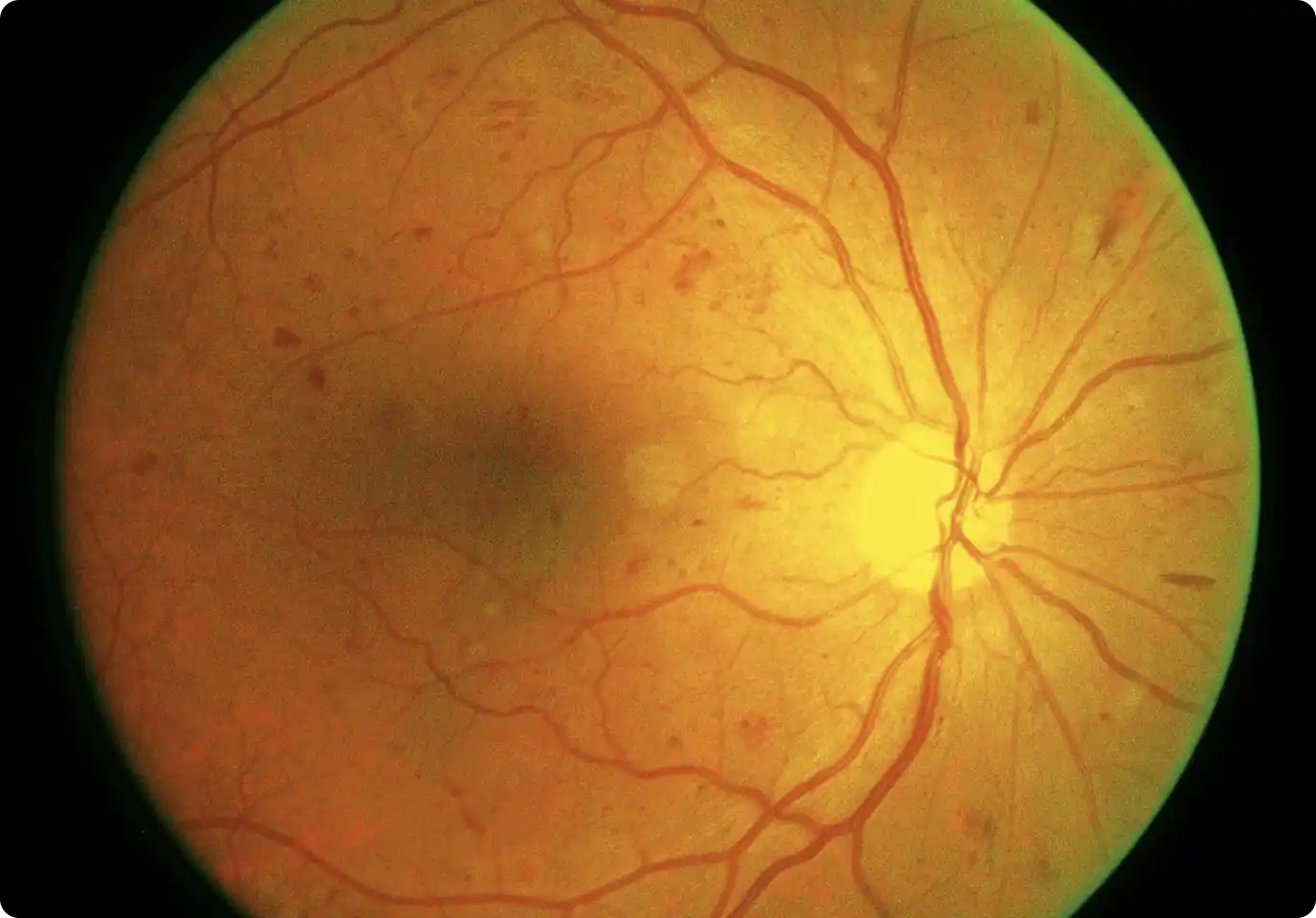 Diabetic Retinopathy (DR) Recognition